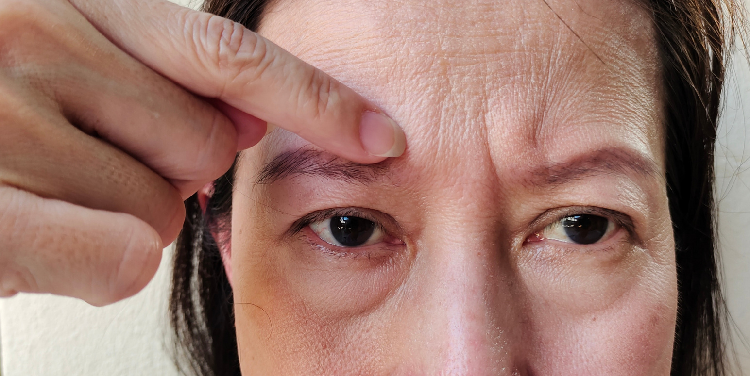 The wrinkle and Flabby skin, forehead lines and Flabbiness skin.