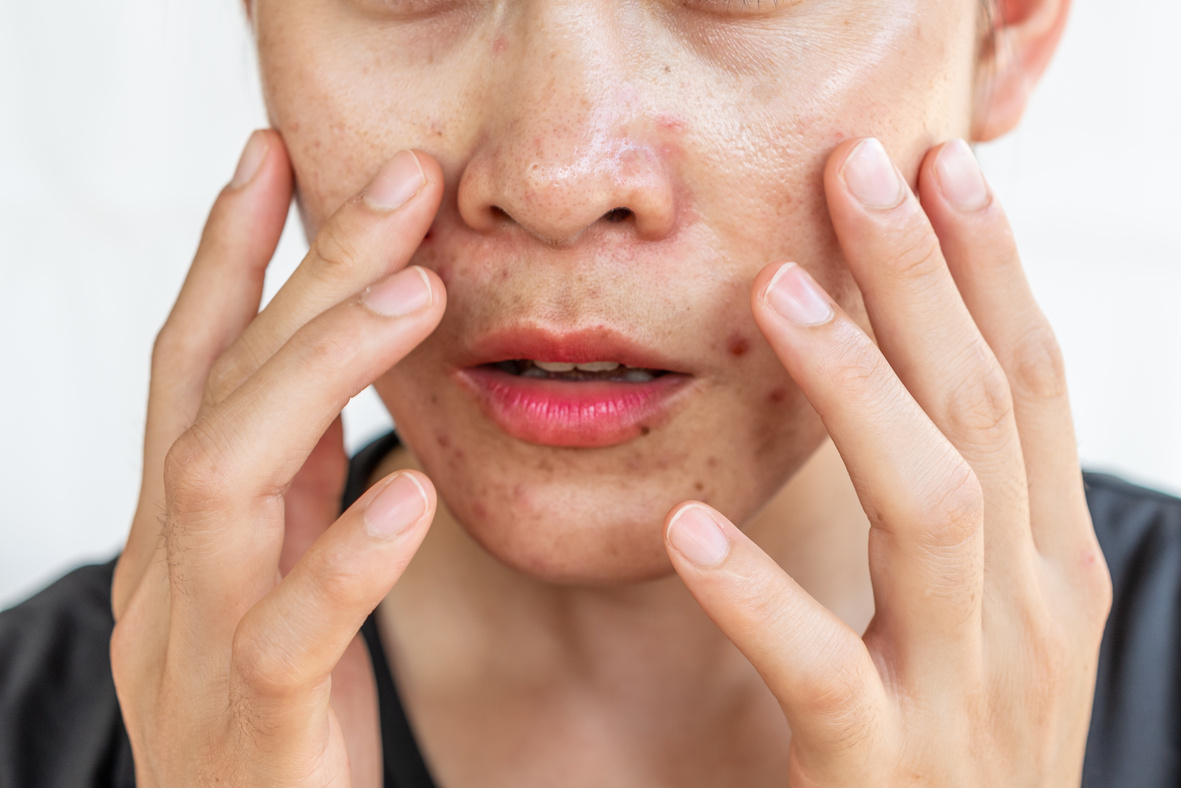 Close up of worried woman having problems of oily skin with acne inflamed on her face.