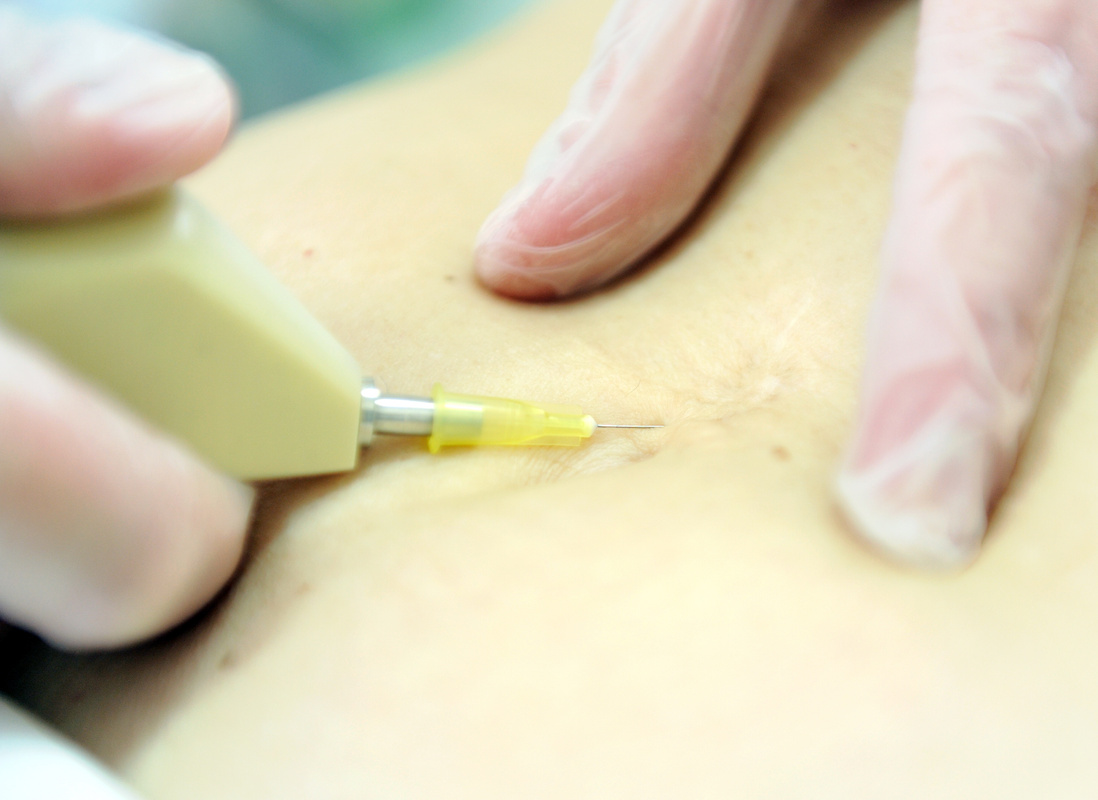 Carbon dioxide therapy (carboxytherapy). Skin rejuvenation.